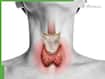 Thyroid Diet 2026: 7 Foods To Avoid If You're Diagnosed With Hypothyroidism