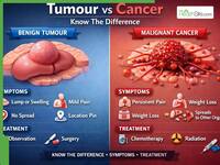 Tumour Vs Cancer: Know The Difference, Symptoms And Treatment