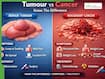 Tumour Vs Cancer: Know The Difference, Symptoms And Treatment