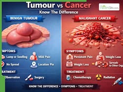Tumour Vs Cancer: Know The Difference, Symptoms, Treatment