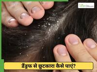 डैंड्रफ से मिलेगा छुटकारा, सन्यासी आयुर्वेदा ने बताया ऐसा घरेलू उपाय