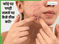 चेहरे से पपड़ी वाले फोड़े कैसे ठीक करें? जानें 5 तरीके, जो देंगे साफ त्वचा