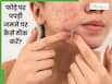 चेहरे से पपड़ी वाले फोड़े कैसे ठीक करें? जानें 5 तरीके, जो देंगे साफ त्वचा
