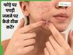 चेहरे से पपड़ी वाले फोड़े कैसे ठीक करें? जानें 5 तरीके, जो देंगे साफ त्वचा