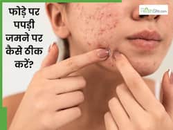 चेहरे से पपड़ी वाले फोड़े कैसे ठीक करें? जानें 5 तरीके, जो देंगे साफ त्वचा
