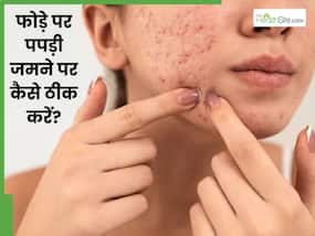 चेहरे से पपड़ी वाले फोड़े कैसे ठीक करें? जानें 5 तरीके, जो देंगे साफ त्वचा