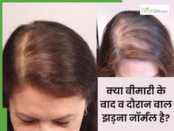 क्या पोस्ट-कोविड और वायरल फीवर जैसी गंभीर बीमारियों के बाद बाल झड़ना नॉर्मल है?