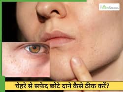 चेहरे से सफेद छोटे दाने क्यों होते हैं? जानें 5 तरीके जो देंगे क्लियर स्किन