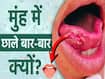 मुंह में छाले बार-बार क्यों होते हैं? जानें कारण और ऐसे में क्या करें