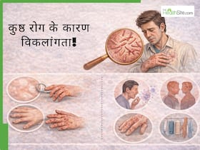 इलाज मुफ्त, फिर भी विकलांगता क्यों? कुष्ठ रोग के मामले में देरी बन रही है जानलेवा