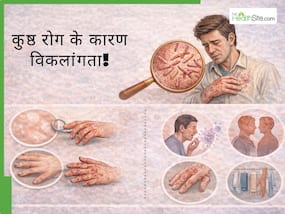 इलाज मुफ्त, फिर भी विकलांगता क्यों? कुष्ठ रोग के मामले में देरी बन रही है जानलेवा इलाज मुफ्त, फिर भी विकलांगता क्यों? कुष्ठ रोग के मामले में देरी बन रही है जानलेवा