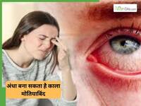 क्या काला मोतिया से होने वाले अंधेपन को रोका जा सकता है? काला मोतिया को रोकने के लिए क्या है जरूरी, बता रहे हैं डॉक्टर