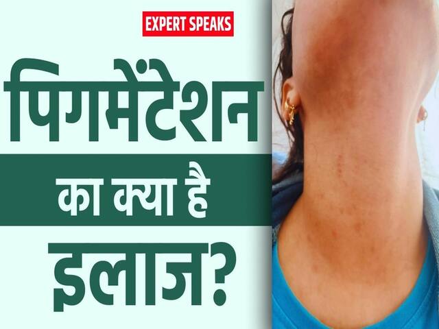 स्किन पिगमेंटेशन क्यों होती है? जानें क्या है इलाज और बचाव का तरीका