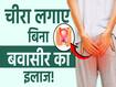 बवासीर का इलाज होगा बिना चीरा लगाए, जानें कैसे?