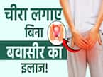 बवासीर का इलाज होगा बिना चीरा लगाए, जानें कैसे?