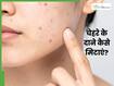 चेहरे पर छोटे-छोटे लाल दाने हो जाए तो क्या करें? जानें 4 उपाय