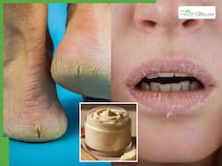 सर्दियों में फटने लगी हैं एड़ियां और होंठ, तो घर पर बनाएं ये लोंग-लास्टिंग मॉइश्चराइजिंग क्रीम