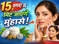 15 रुपए में मिट जाएंगे चेहरे के सारे मुंहासे, बस इस तरह से अप्लाई करें यह सस्ता घरेलू उपाय