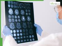 Your Eyes Could Predict Alzheimer’s Disease: New Study Links Sinus And Pneumonia Bacteria To Brain Disorder