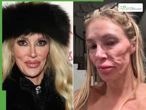 Brandi Glanville Reveals Completely Ruptured Breast Implants Behind Facial Parasite Scare Brandi Glanville Reveals Completely Ruptured Breast Implants Behind Facial Parasite Scare