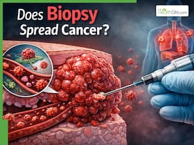 Can a Biopsy Spread Cancer? Doctor Bust The Biggest Myth That Delays Diagnosis
