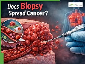 Can a Biopsy Spread Cancer? Doctor Bust The Biggest Myth That Delays Diagnosis