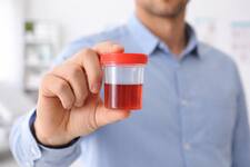 Blood In Urine: Should You Be Worried if You Spot This?