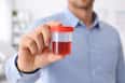 Blood In Urine: Should You Be Worried if You Spot This?