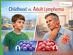 Childhood vs Adult Lymphoma: Differences In Causes, Diagnosis, Treatment And Survival Rates