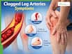 Clogged Leg Arteries Symptoms: 5 Warning Signs of Peripheral Artery Disease (PAD) You Shouldn’t Ignore