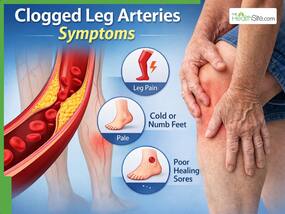 Clogged Leg Arteries Symptoms: 5 Warning Signs of Peripheral Artery Disease (PAD) You Shouldn   t Ignore
