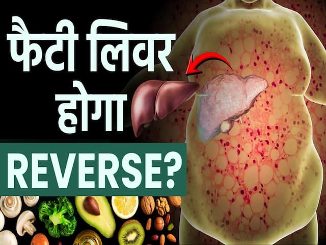 फैटी लिवर ठीक हो सकता है? जानें डाइट और लाइफस्टाइल में क्या करें बदलाव