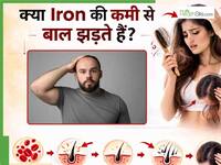 क्या आयरन की कमी से बाल झड़ते हैं? जानें, Iron Deficiency कैसे है गंजेपन की वजह