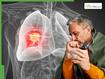 World Cancer Day 2026: 5 Often Ignored Signs of Lung Cancer That Show Up In Eyes