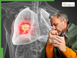 World Cancer Day 2026: 5 Often Ignored Signs of Lung Cancer That Show Up In Eyes