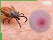 Lyme Disease Surge 2026: Six Early Symptoms That Often Go Unnoticed