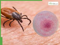 Lyme Disease Surge 2026: Six Early Symptoms That Often Go Unnoticed
