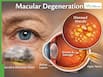 Macular Degeneration: Early Symptoms That Appear Before Vision Loss