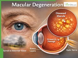 Macular Degeneration: Early Symptoms That Appear Before Vision Loss