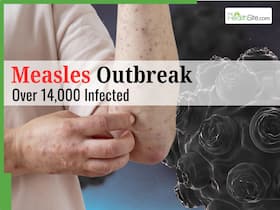 Measles Outbreak Explodes in Mongolia: 14,000+ Infected as Children Face High Fever, Pneumonia, Brain Swelling Risk Measles Outbreak Explodes in Mongolia: 14,000+ Infected as Children Face High Fever, Pneumonia, Brain Swelling Risk