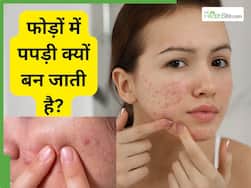 फेस से सूखे-पपड़ीदार फोड़ों को कैसे ठीक करें?