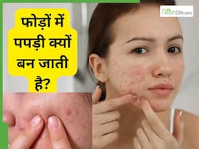 फेस से सूखे-पपड़ीदार फोड़ों को कैसे ठीक करें?