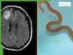 Rare Parasite Discovered In Woman’s Lungs Triggers Organ Damage And Memory Loss, Doctor Reveals