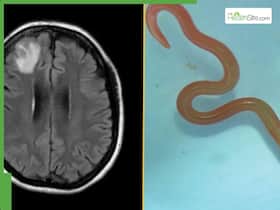 Rare Parasite Discovered In Woman’s Lungs Triggers Organ Damage And Memory Loss, Doctor Reveals