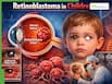 Retinoblastoma: The Most Common Eye Cancer In Children, Warning Signs Parents Must Not Ignore