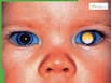 Retinoblastoma: The Most Common Eye Cancer In Children, Warning Signs Parents Must Not Ignore