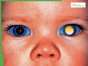 Retinoblastoma: The Most Common Eye Cancer In Children, Warning Signs Parents Must Not Ignore Retinoblastoma: The Most Common Eye Cancer In Children, Warning Signs Parents Must Not Ignore