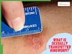 What Is Sexually Transmitted Ringworm Spreading In United States? Symptoms, Risks And What To Know