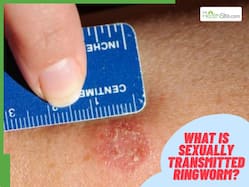 What Is Sexually Transmitted Ringworm Spreading In United States? Symptoms, Risks And What To Know