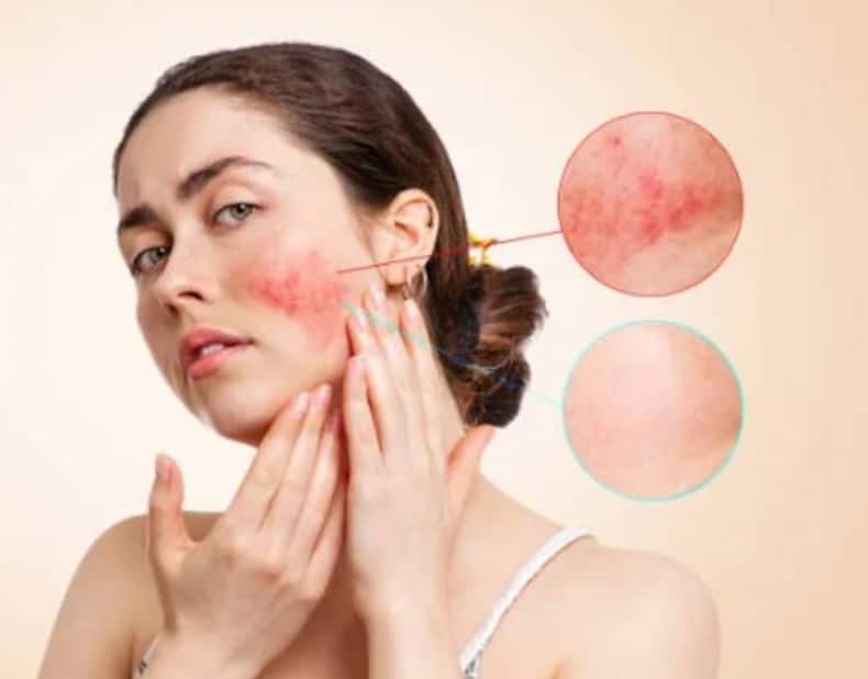 Rose Water For Face: 5 Amazing Benefits For Glowing, Acne-Free Skin